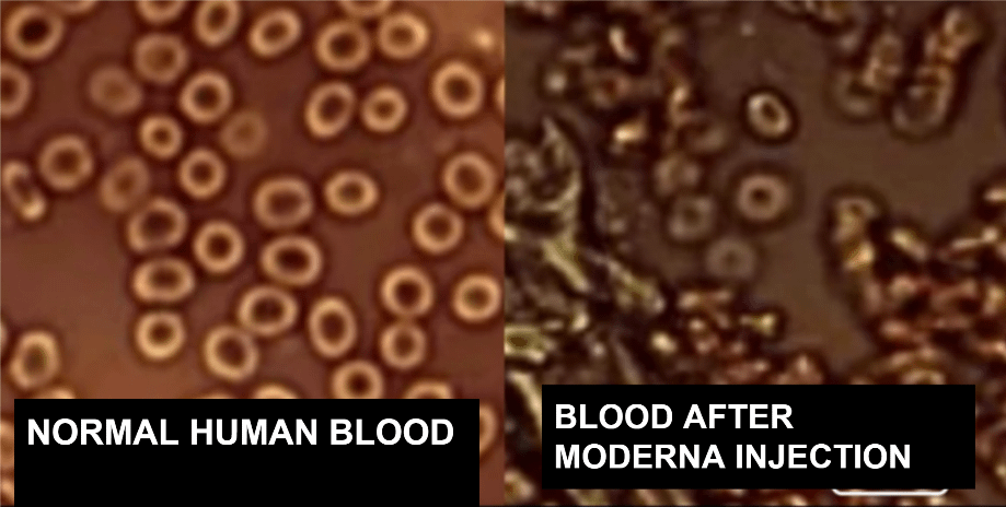 normal blood vs Moderna injection blood